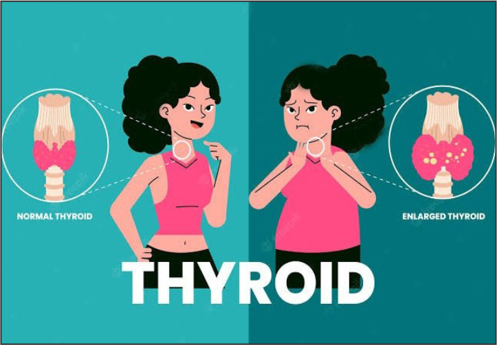 Thyroid Problems